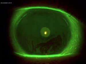 Thermal Therapies For Dry Eye and MGD