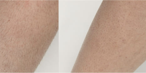 Hair-Removal-Body-Image-1