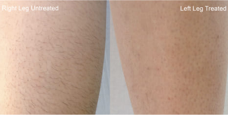 Hair-Removal-Body-Image-2